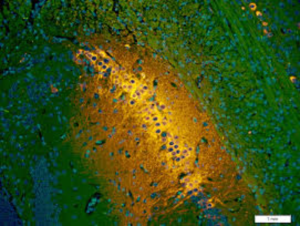 This image shows an oncolytic virus infecting and killing tumour cells. When the tumour cells become infected with virus, they glow green. When the tumour cells die, they glow red. Where you have a virus infecting (green) and killing (red) in the same tumour cell, these green and red colours merge into yellow.